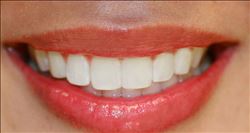 Diş sıkma alışkanlığı geceleri kendini gösteriyor