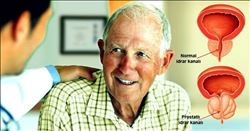 PROSTAT SAĞLIĞI İÇİN TÜKETİLMESİ GEREKENLER