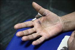 Tetik parmak hastalığı